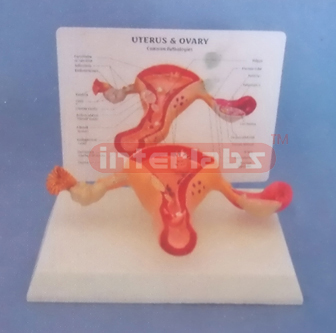 WEST DESK TYPE, COMMON PATHOLOGIES UTERUS & OVARY WITH DESCRIPTION PLATE(2PCS) WITHOUT COVER AND THE LESSER LIPS OF PUDENDUM